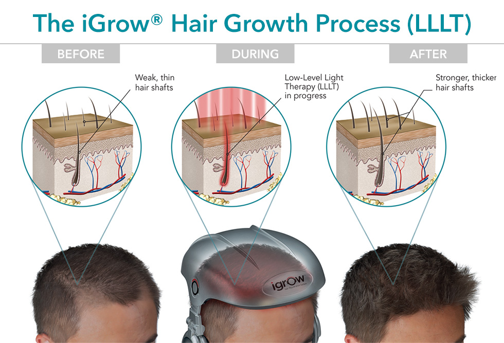 The iGrow® Hair Growth Process (LLLT)