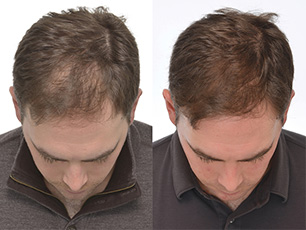 iGrow Before and After