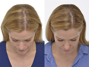iGrow Before and After