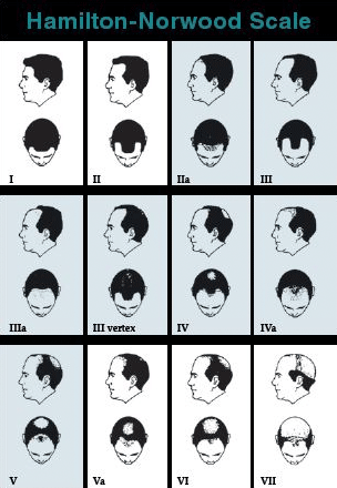 Hamilton-Norwood Scale