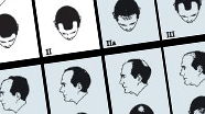 Identify your hair-loss level