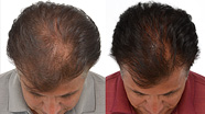 iGrow hair regrowth results